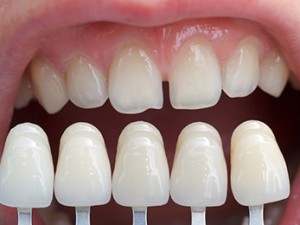 REMPLACER UNE OU PLUSIEURS DENTS MANQUANTES